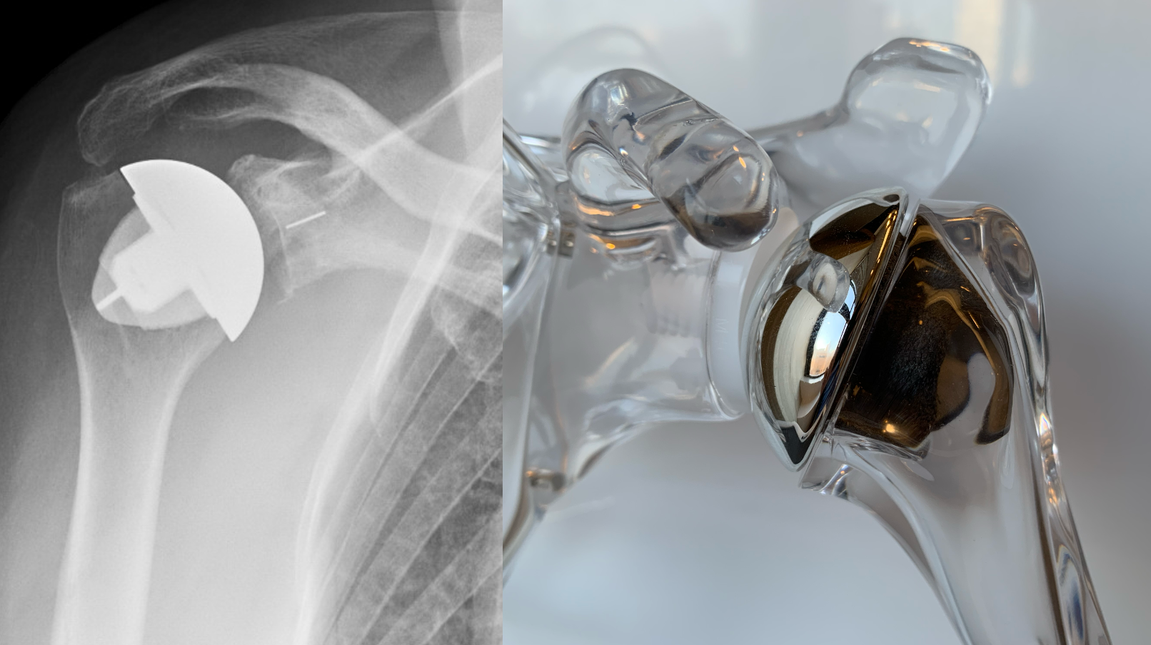 Total Shoulder Replacement (Anatomic and Reverse) - HSS Shoulder